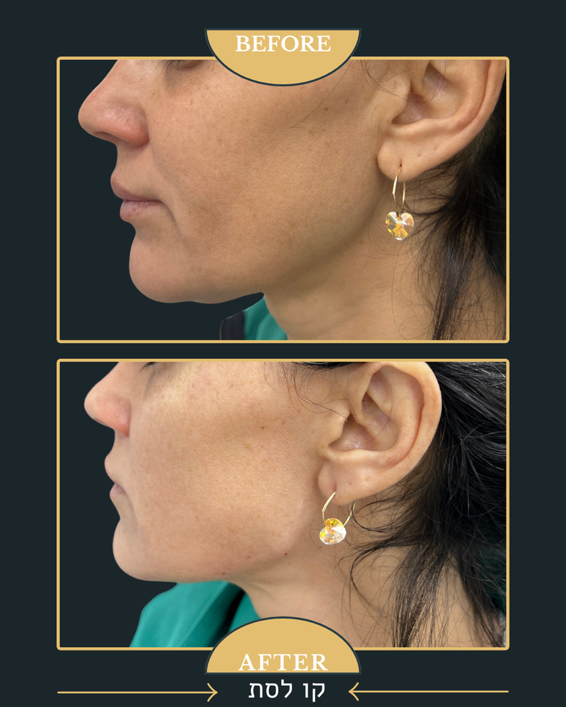 פיסול פנים מלא קו לסת \ פיסול אף \ נזולביאל \ עצמות לחיים...