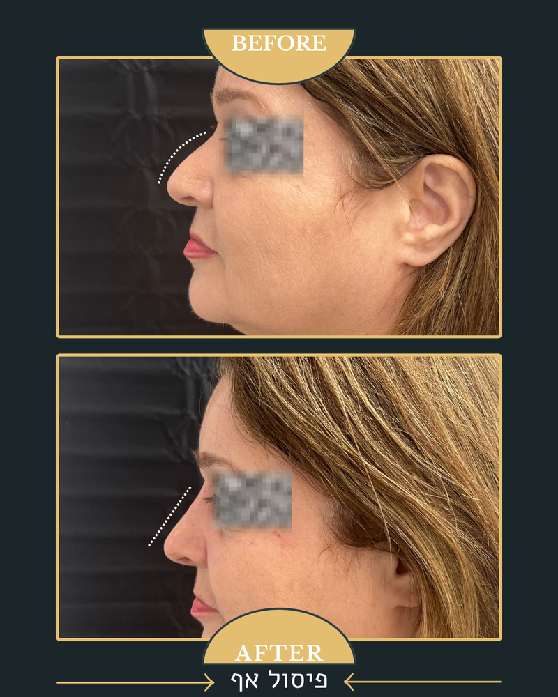 פיסול פנים מלא קו לסת \ פיסול אף \ נזולביאל \ עצמות לחיים...