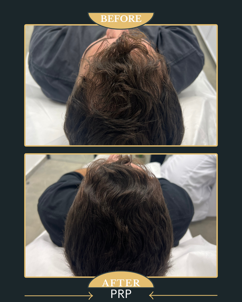 טיפול PRP לעצירת נשירת השיער ועיבוי השערה 
