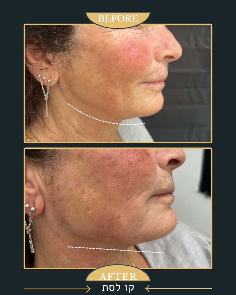 פיסול פנים מלא קו לסת \ פיסול אף \ נזולביאל \ עצמות לחיים...