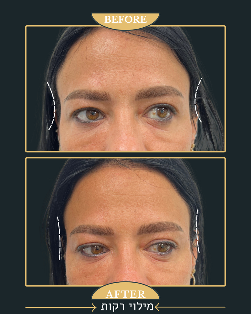 פיסול פנים מלא קו לסת \ פיסול אף \ נזולביאל \ עצמות לחיים...