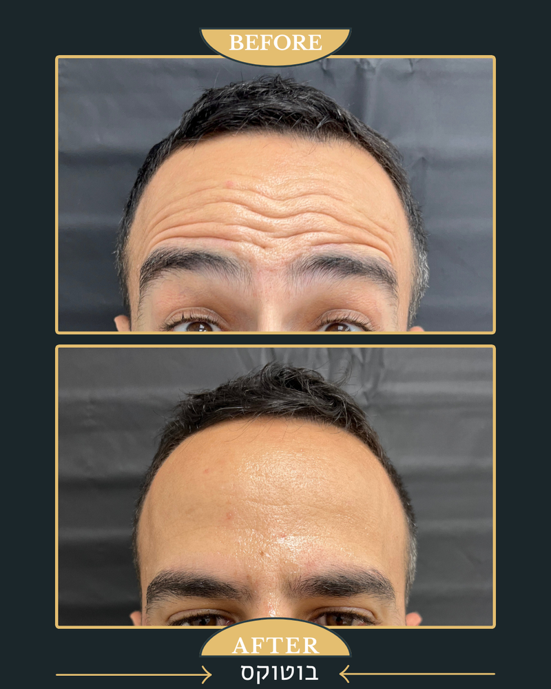 מתיחה וזוהר בזכות בוטוקס