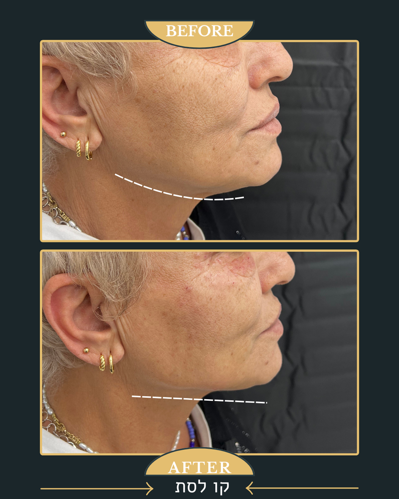 פיסול פנים מלא קו לסת \ פיסול אף \ נזולביאל \ עצמות לחיים...