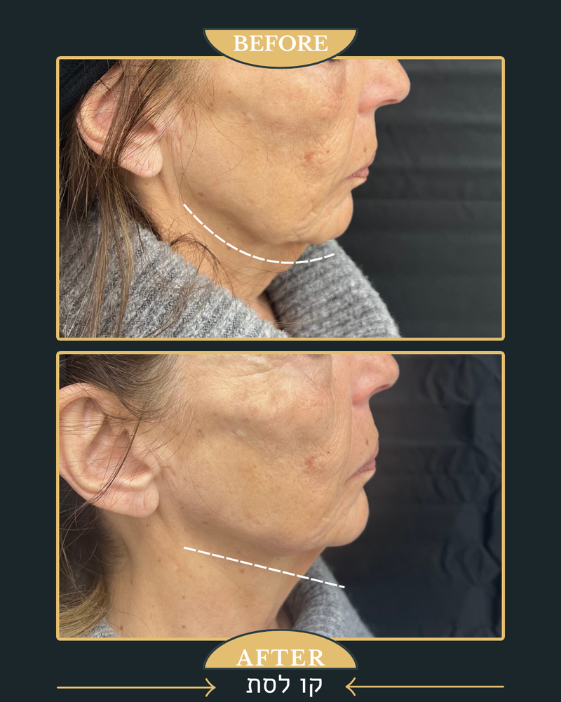 פיסול פנים מלא קו לסת \ פיסול אף \ נזולביאל \ עצמות לחיים...