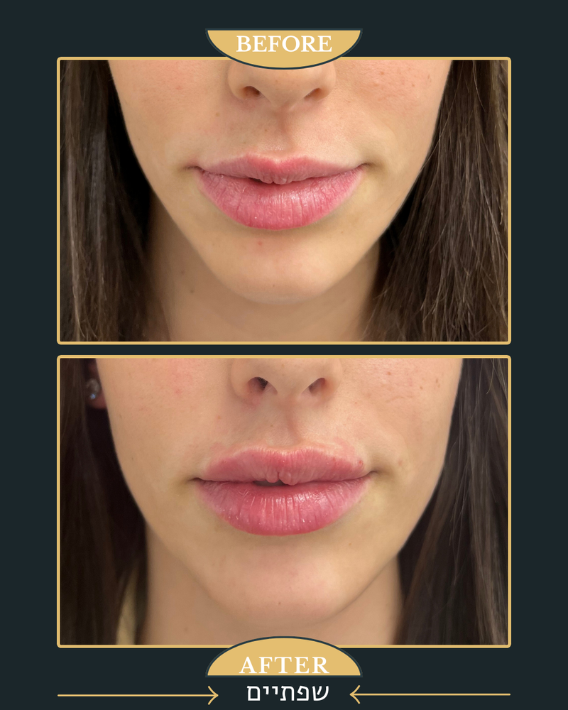 מילוי שפתיים 