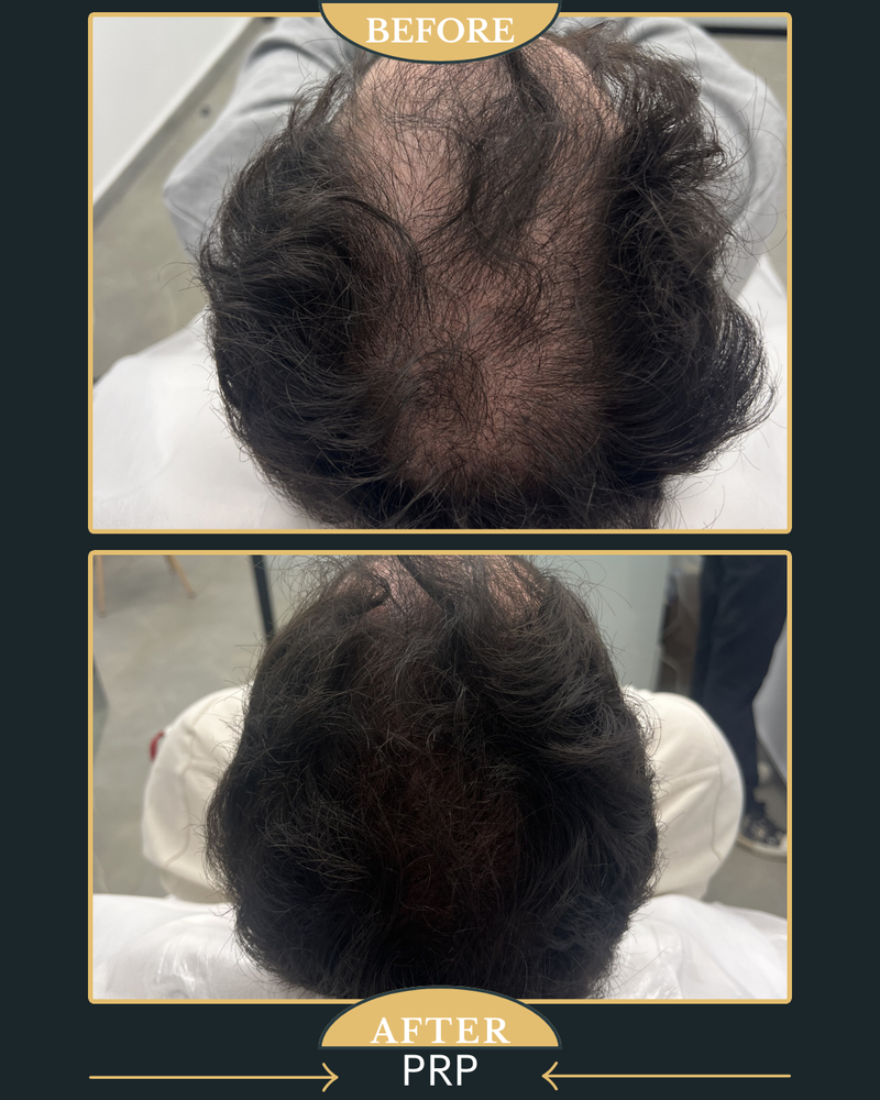 טיפול PRP לעצירת נשירת השיער ועיבוי השערה 
