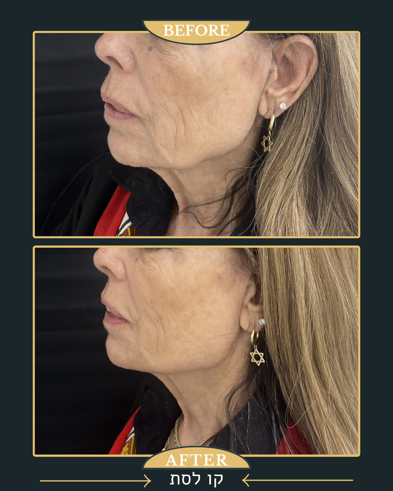 פיסול פנים מלא קו לסת \ פיסול אף \ נזולביאל \ עצמות לחיים...