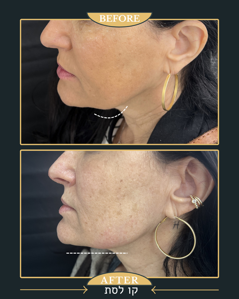 פיסול ומתיחה של קו הלסת