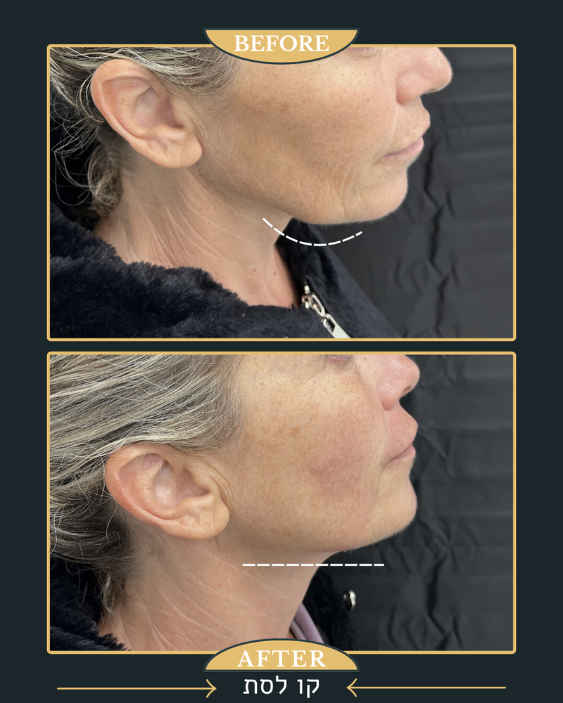 פיסול ומתיחה של קו הלסת