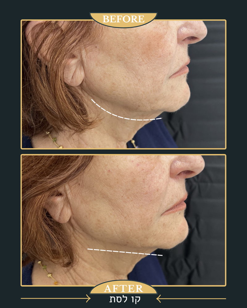 פיסול ומתיחה של קו הלסת