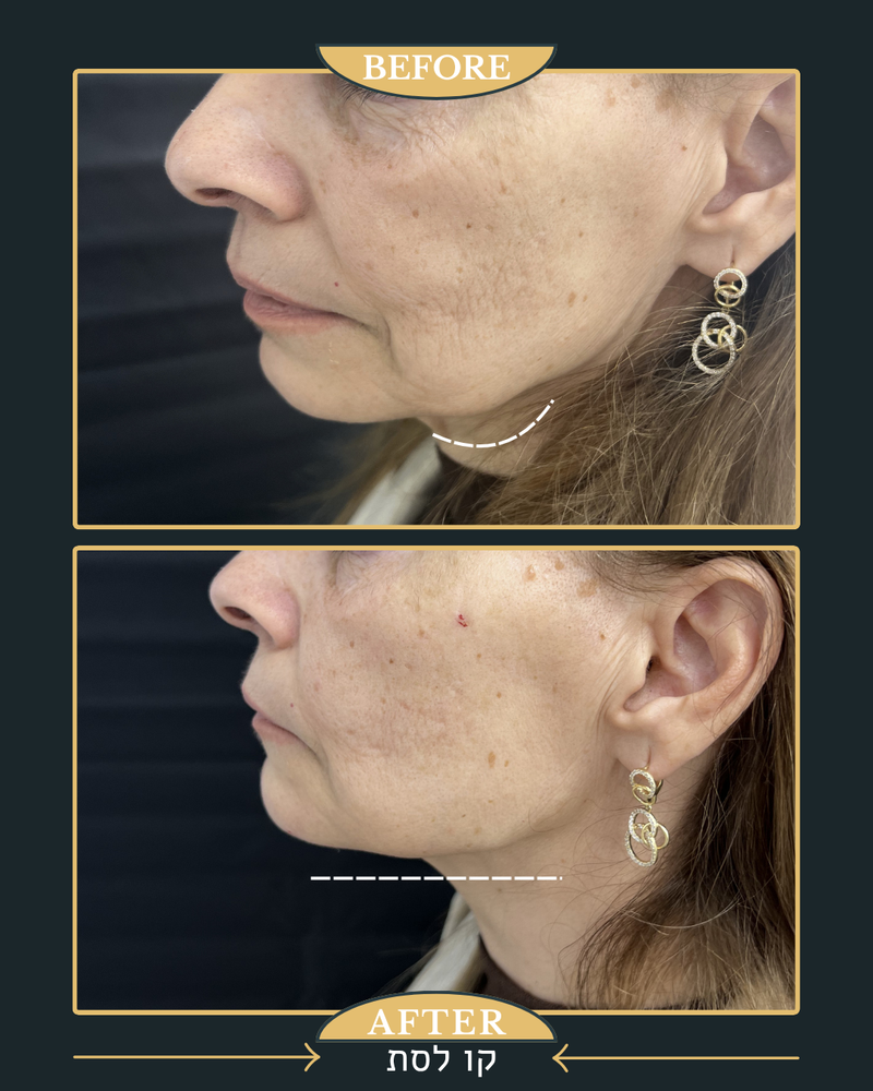 פיסול ומתיחה של קו הלסת