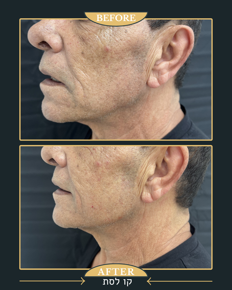 פיסול ומתיחה של קו הלסת