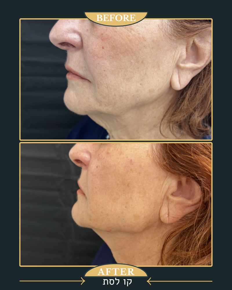 פיסול ומתיחה של קו הלסת