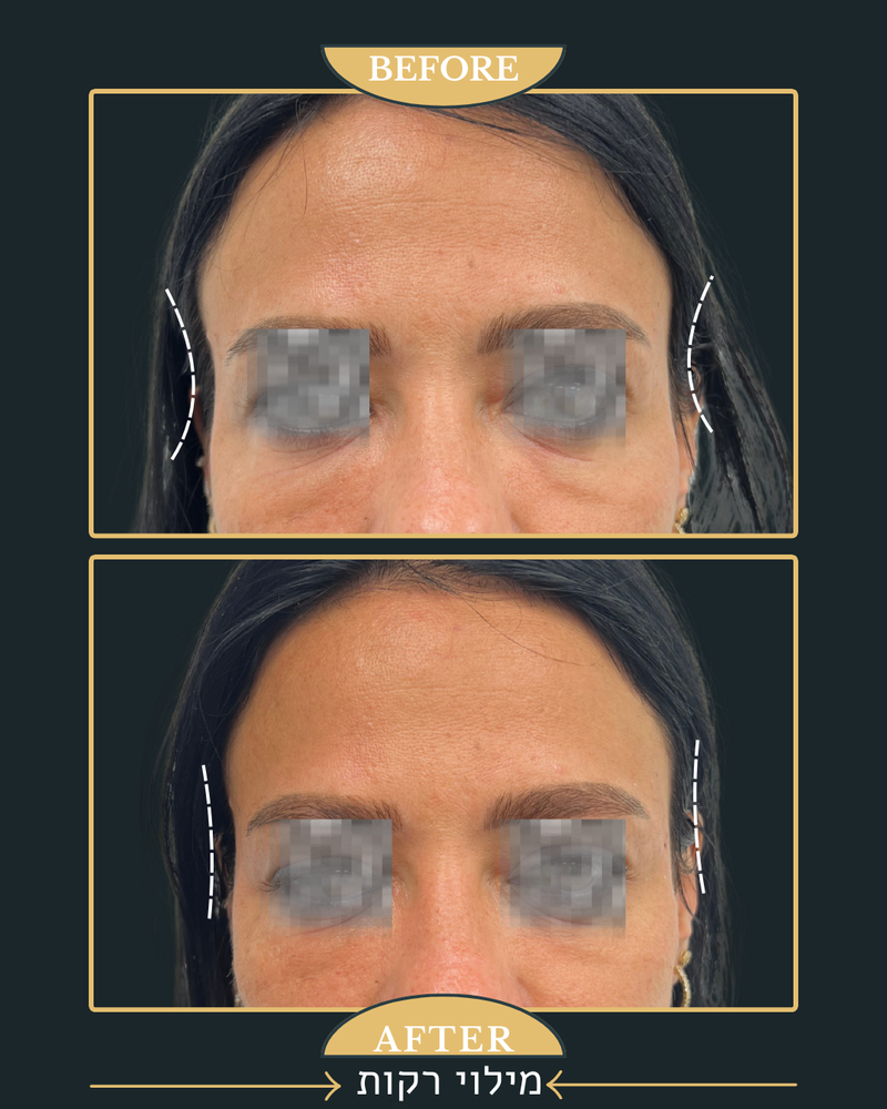 מתיחת קמת הנזולביאל ומילוי רקות 