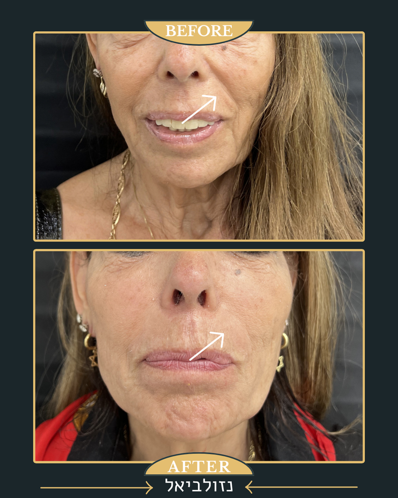 מתיחת קמת הנזולביאל ומילוי רקות 