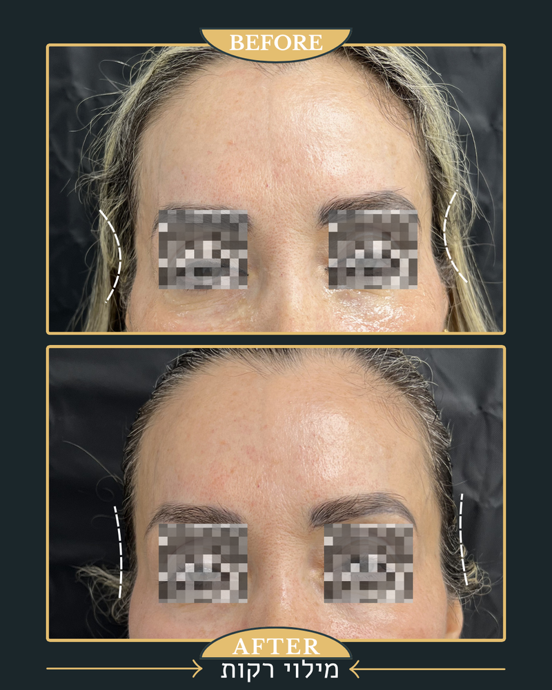 מתיחת קמת הנזולביאל ומילוי רקות 