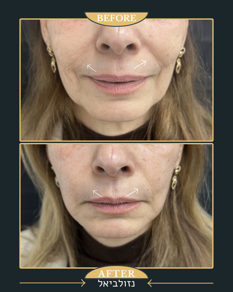 מתיחת קמת הנזולביאל ומילוי רקות 