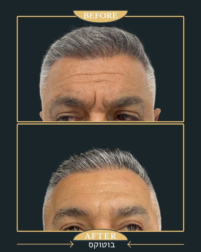 בוטוקס להעלמת קמטים 