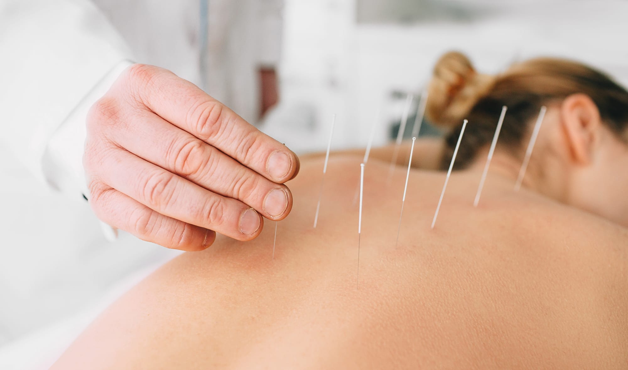 Acupuncture/Dry needling for muscle and tendon pain.