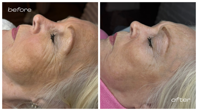 Advanced Skin Treatments