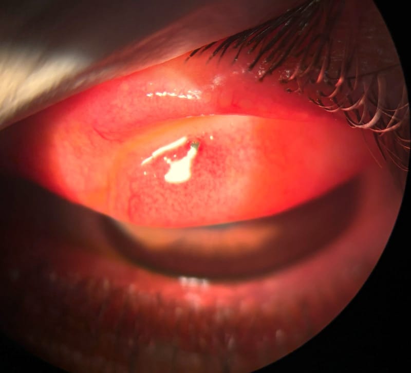 🎁👁 AULA BÔNUS 01 – EVERSÃO PALPEBRAL, CURATIVO OCULAR & OCLUSÃO PALPEBRAL!
