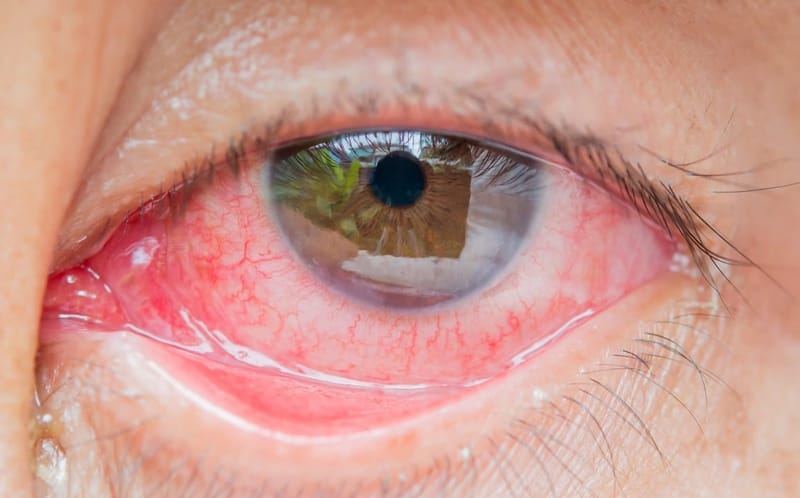 👁 DIAGNÓSTICOS DIFERENCIAIS DE OLHO VERMELHO & CRISE DE GLAUCOMA AGUDO – O QUE TODO MÉDICO PRECISA SABER!