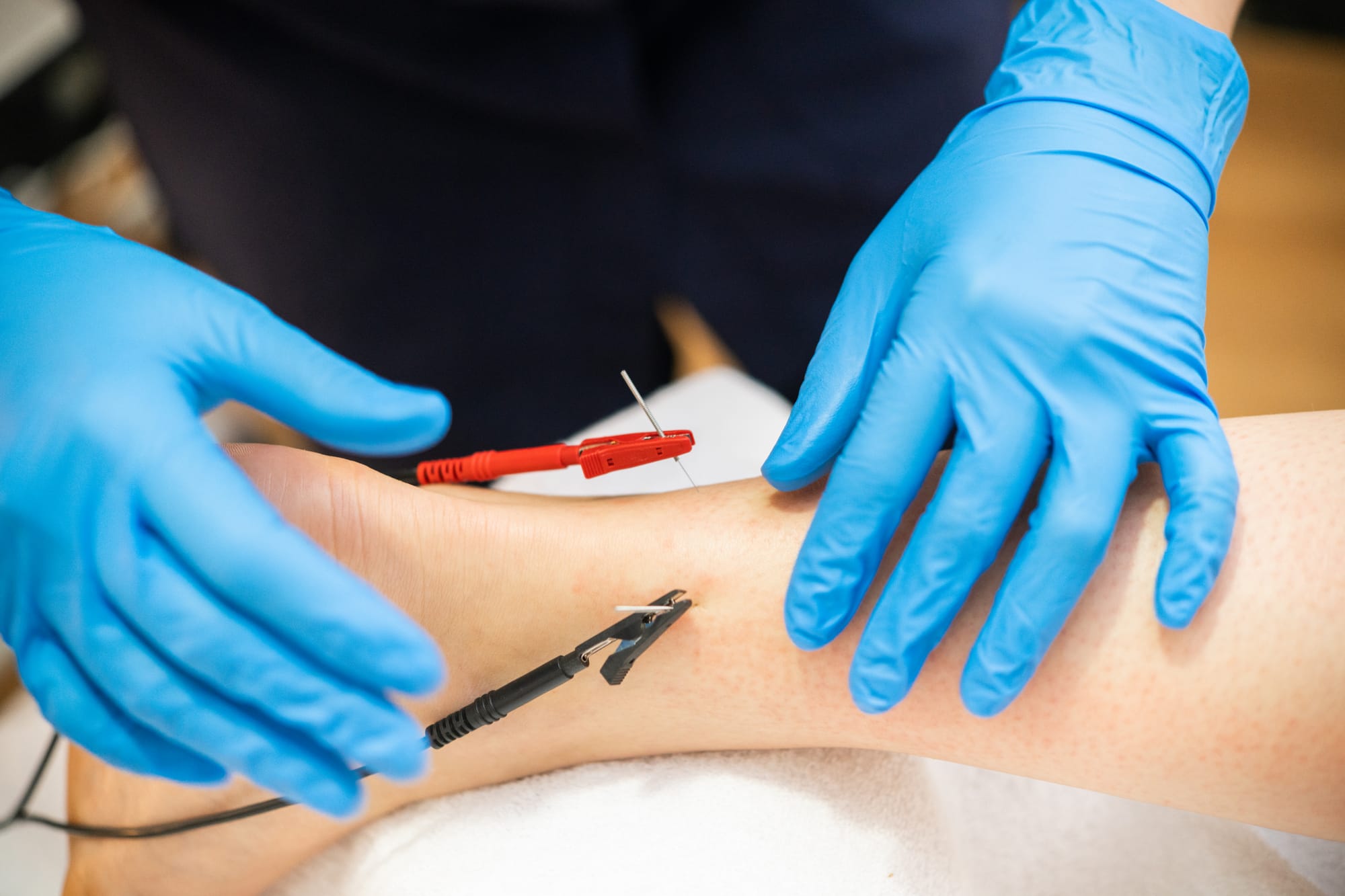 Electro Dry Needling