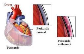 Témoignage - péricardite sèche aïgue