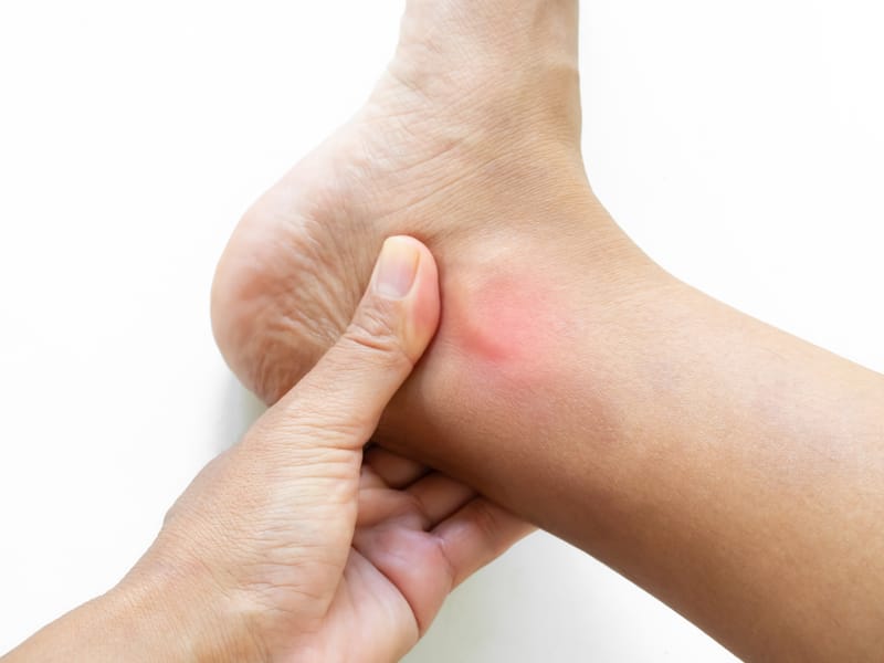 Esguinces de tobillo: tipos, causas y rehabilitación en FIDOCOR (Oleiros, A Coruña)