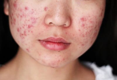 Mụn Trứng Cá: Nguyên Nhân và Những Cách Trị Mụn Hiệu Quả
