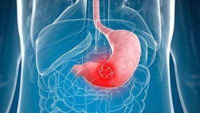 Vì Sao Đau Dạ Dày Cứ Mãi Tái Phát? Cảnh Báo Từ Việc Tự Ý Dùng Kháng Axit Và Giải Pháp Hỗ Trợ Từ Pantoloc
