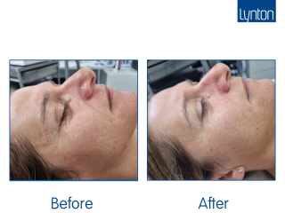 Illumi Course of 6 facials... 1 a month for 6 months....£300.00