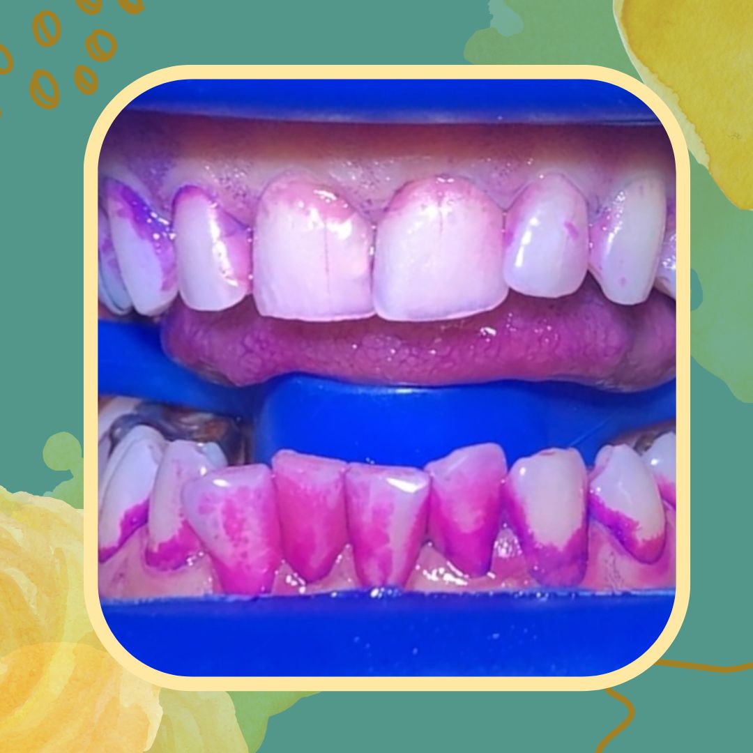 The End of 'Blind' Dentistry: Why Calgary NW is Moving Beyond Traditional Scaling
