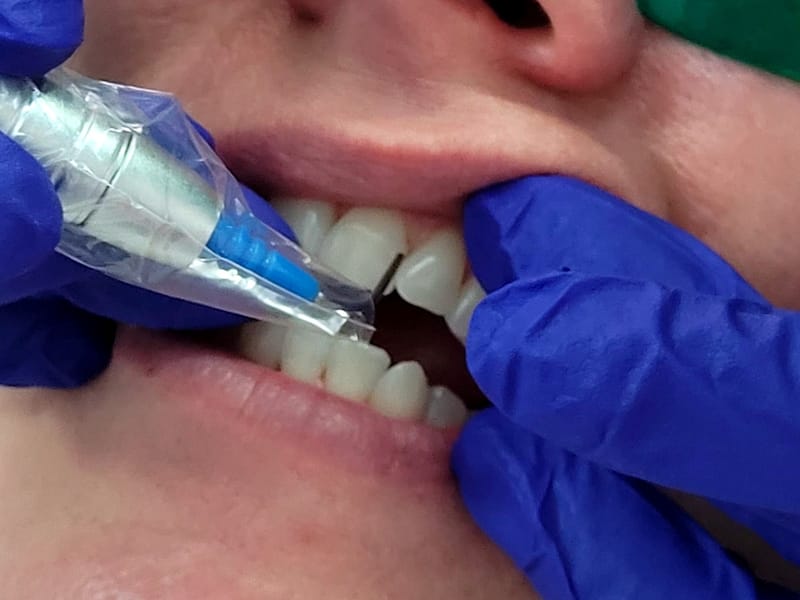 Laser Therapy for Gum Health