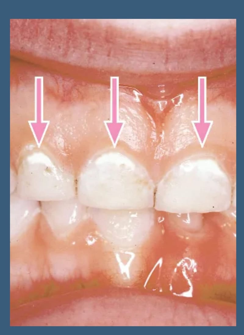 White Spots on Your Teeth: What Do They Mean and What Can You Do?