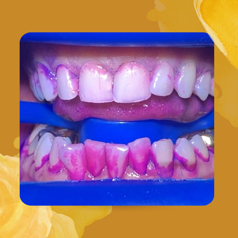 Guided Biofilm Therapy