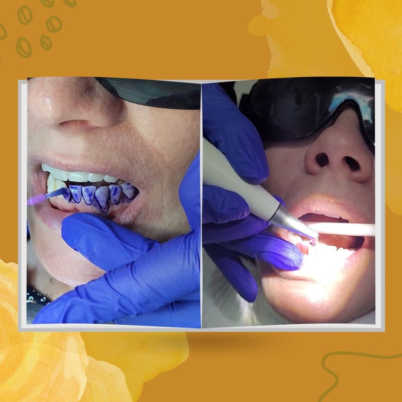 Guided Biofilm Therapy