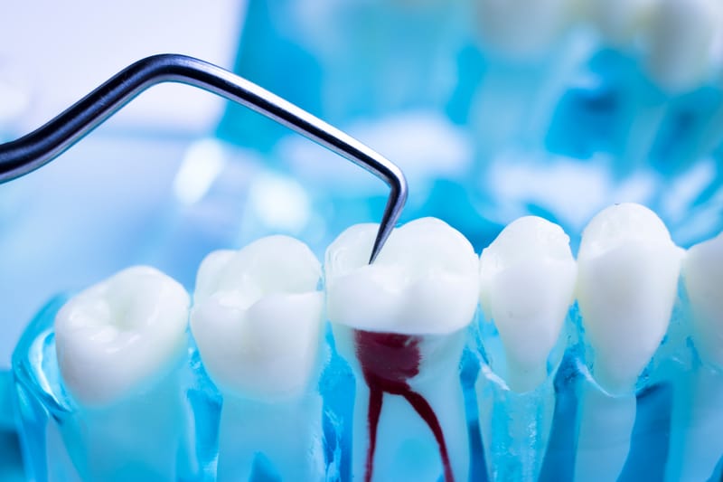 Root Canal Treatment from a Holistic Perspective