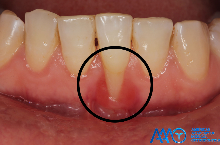 Diş Eti Çekilmesi Geri Döner mi? Gerçekten Ne Mümkün, Ne Değil?