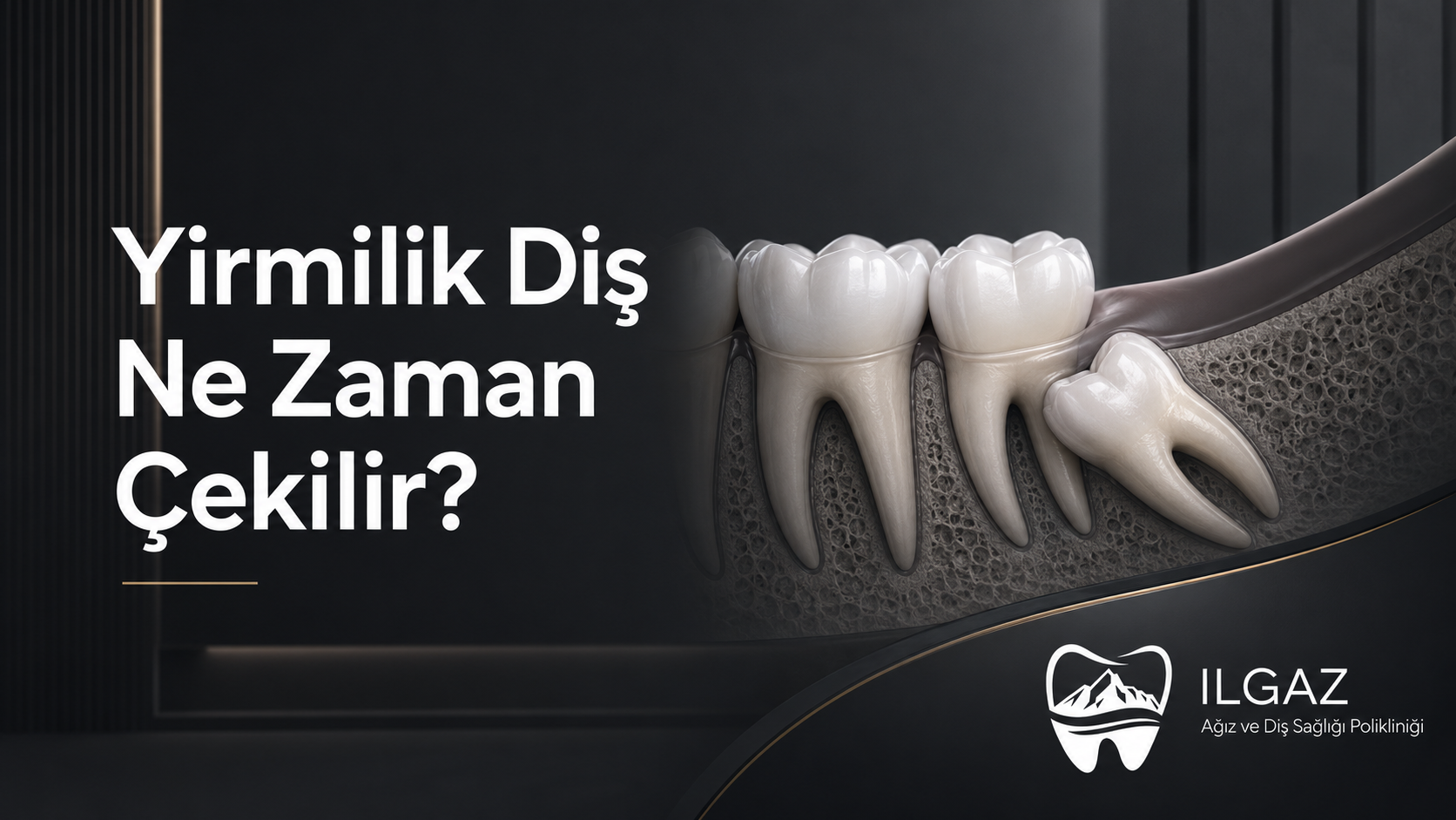 20’lik Diş Ne Zaman Çekilir? Gömülü 20’lik Diş Rehberi