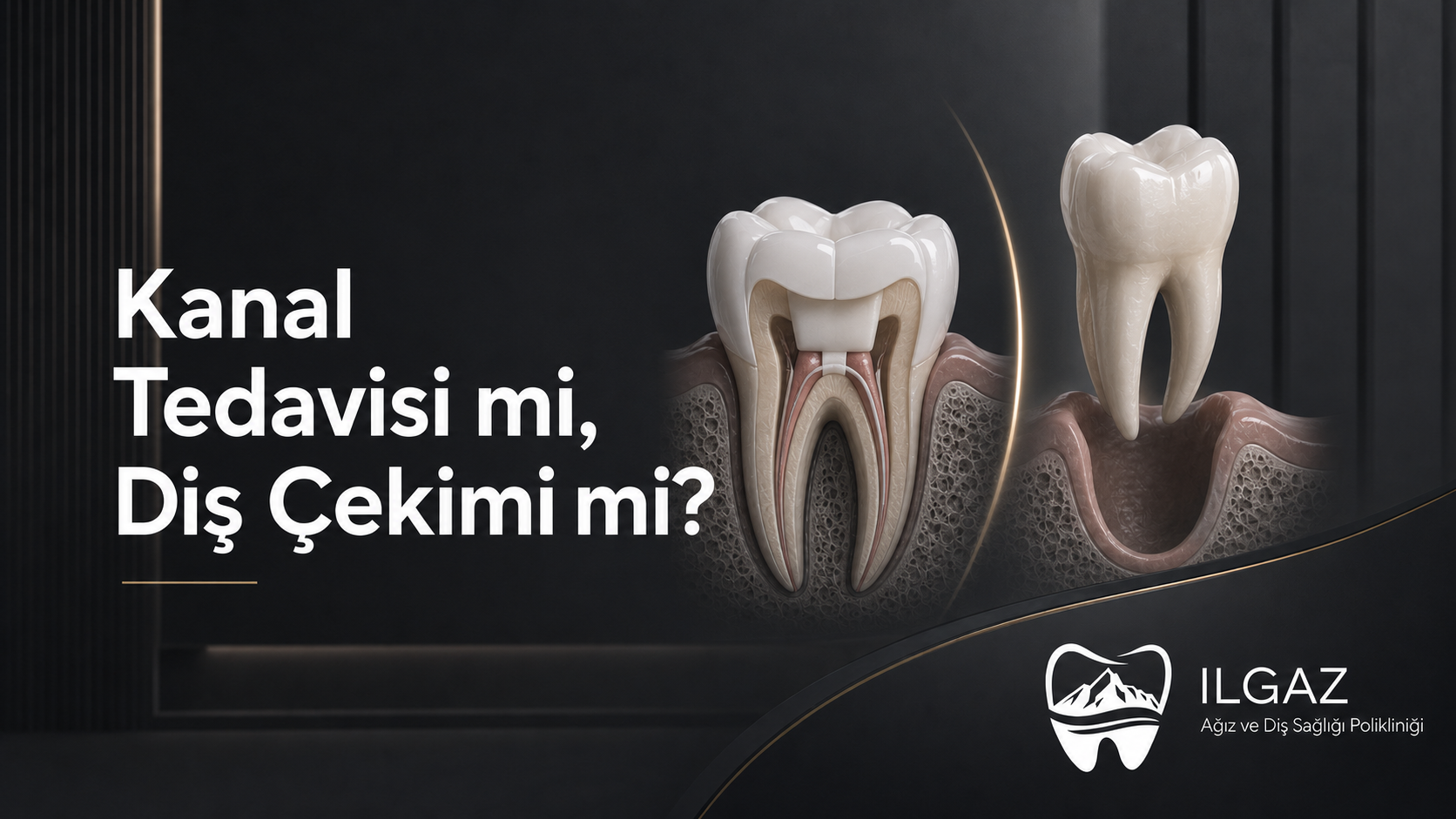 Kanal Tedavisi mi, Diş Çekimi mi? Hangi Durumda Hangisi Daha Doğru?