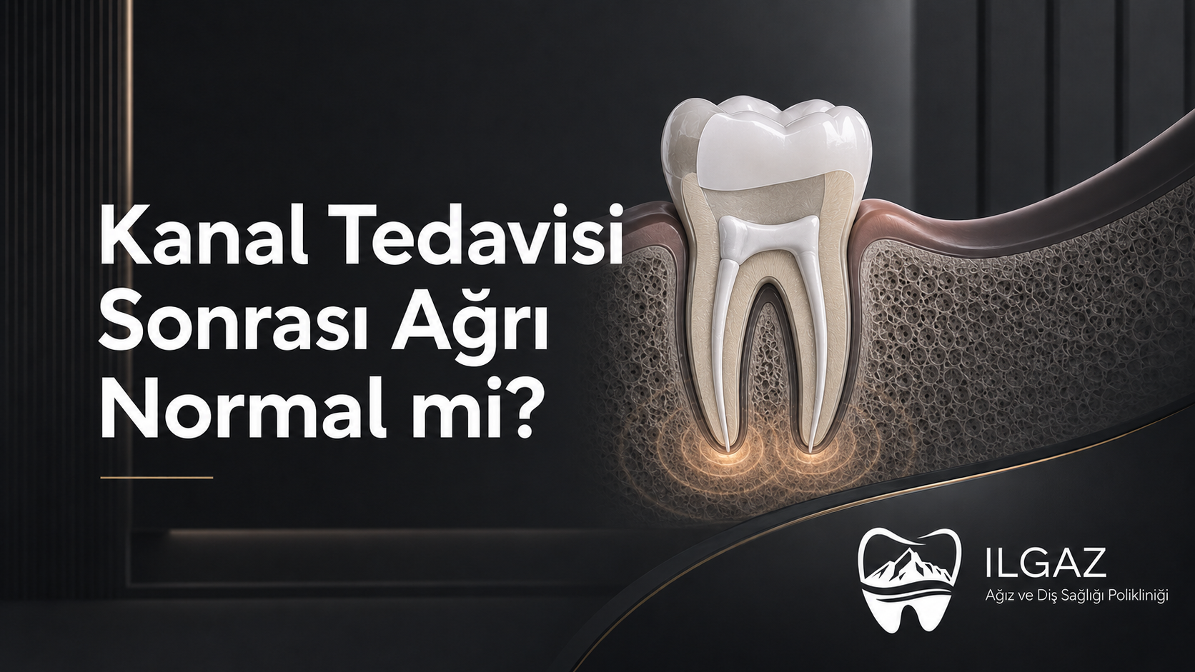 Kanal Tedavisi Sonrası Ağrı Normal mi?