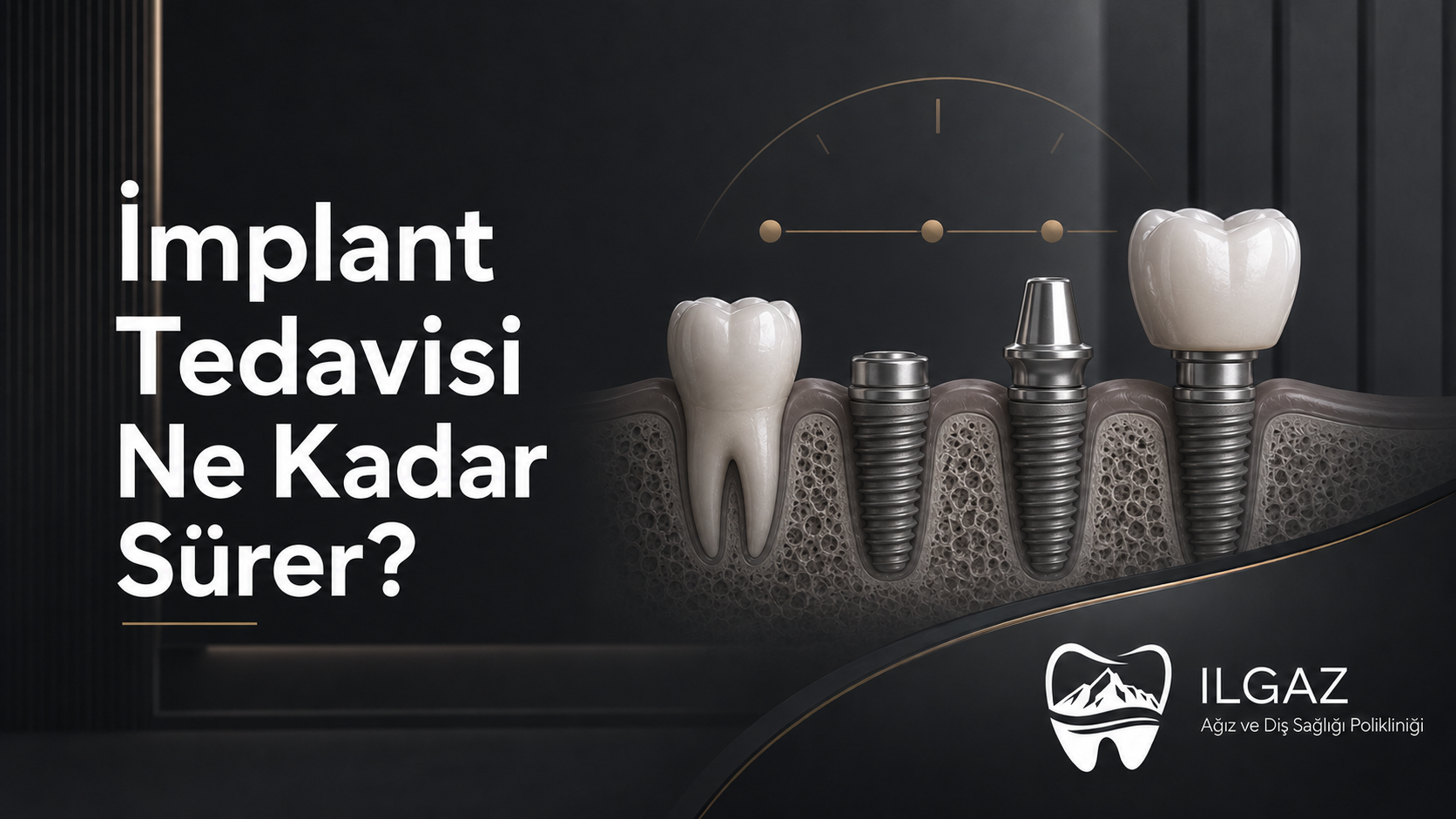 İmplant Tedavisi Ne Kadar Sürer? Aşamalar ve İyileşme Süreci
