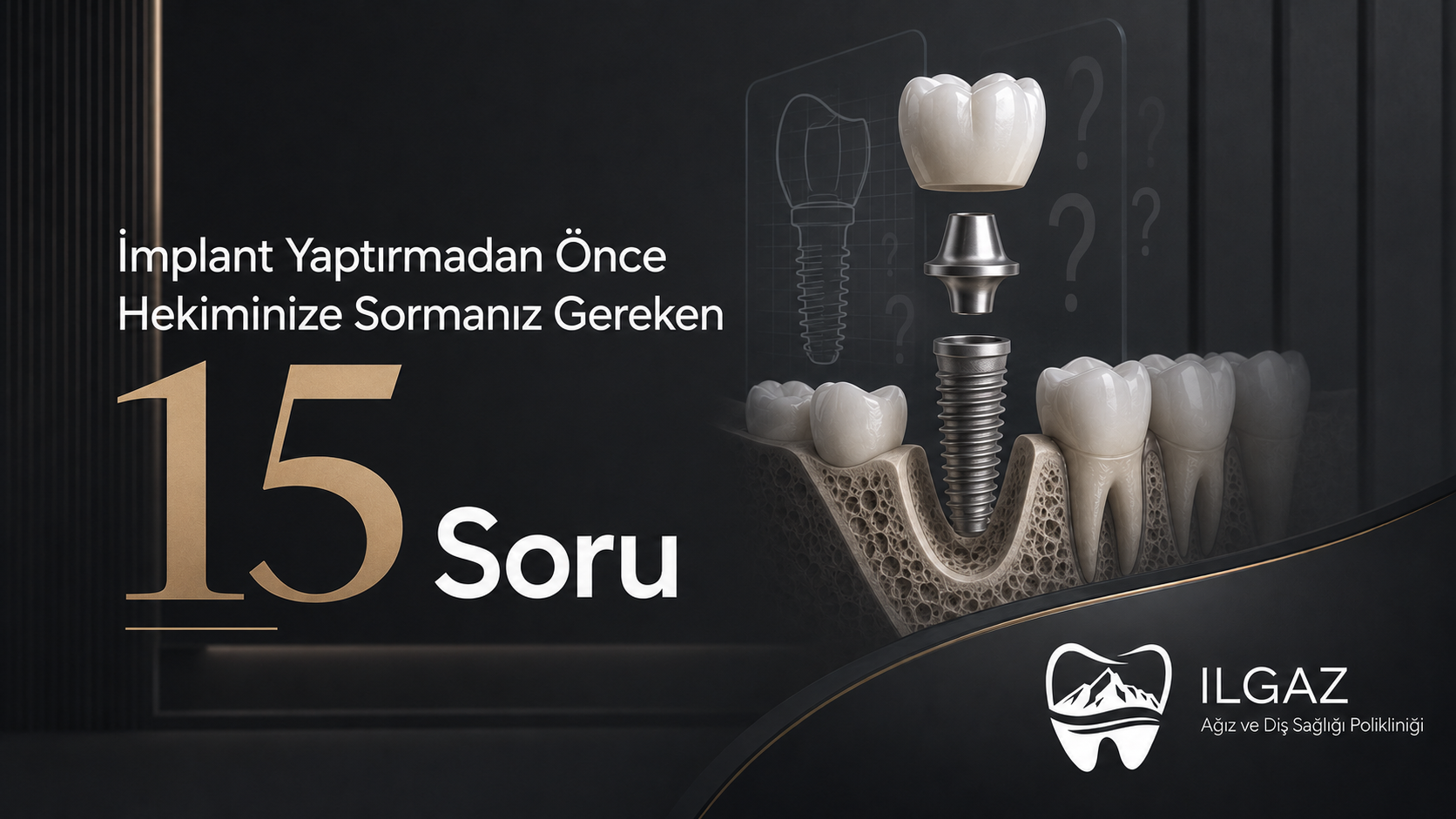 İmplant Yaptırmadan Önce Hekiminize Sormanız Gereken 15 Soru