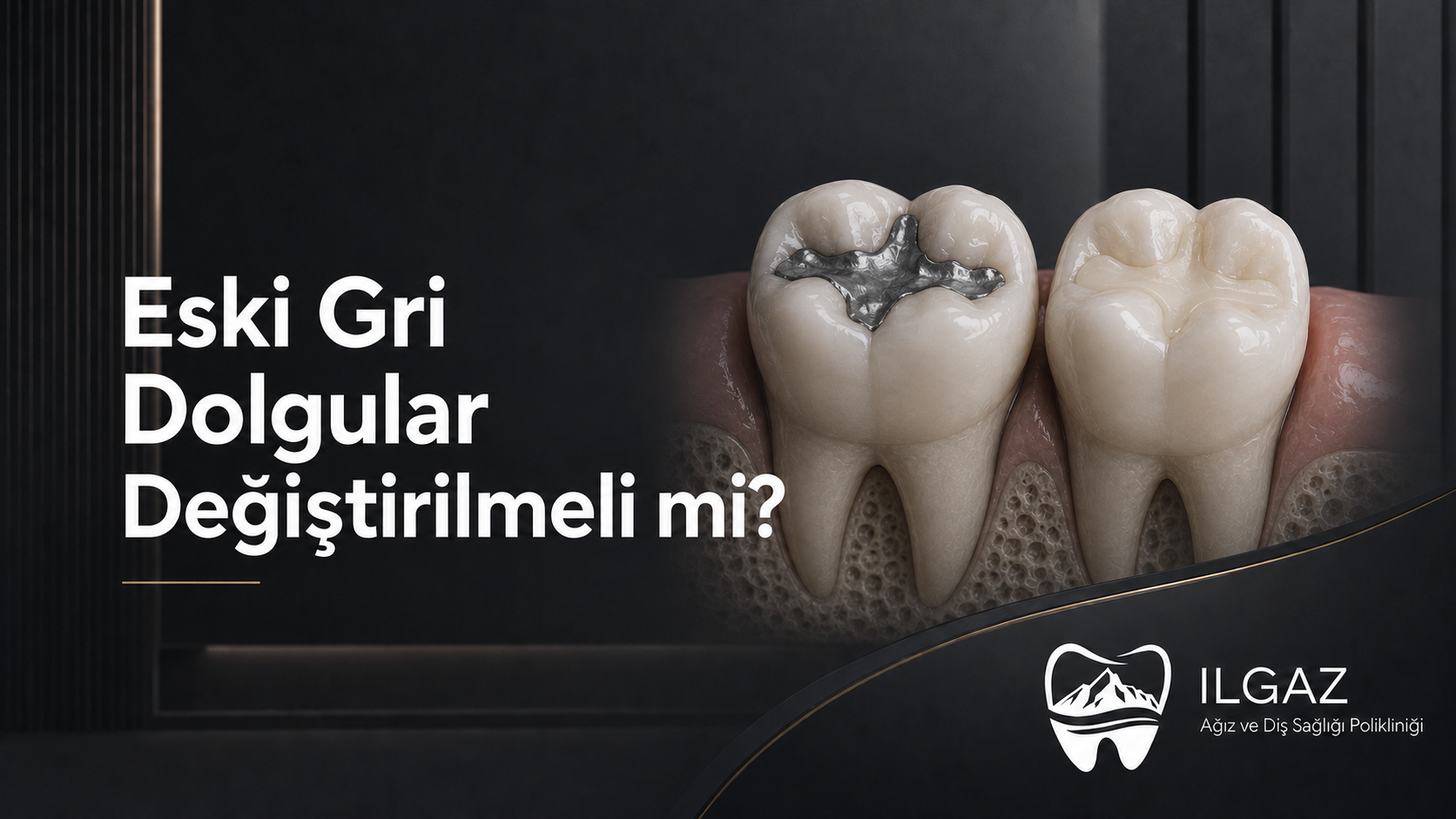 Eski Gri Dolgular Değiştirilmeli mi? Her Amalgam Dolgu Sökülür mü?
