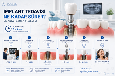 İmplant Tedavisi Ne Kadar Sürer? Gerçekçi Zaman Çizelgesi