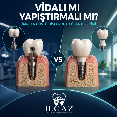 Vidalı mı Yapıştırmalı mı? İmplant Üstü Dişlerde Bağlantı Seçimi