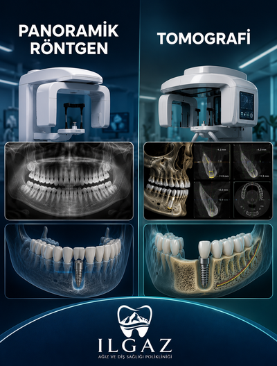 İmplant Planlamasında Panoramik Röntgen ve Dental Tomografi Farkı