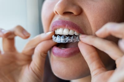 Invisalign Braces in Arlington VA: Modern Solutions for Perfect Alignment