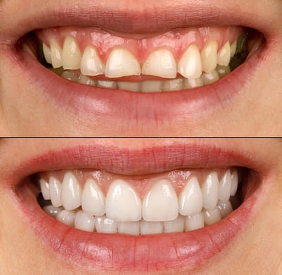 Before and After: Real-Life Transformations with Dental Crowns in Arlington